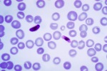 getting malaria in mali